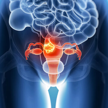 Ooforectomia: protezione da tumore mammario differisce con mutazioni BRCA1/2