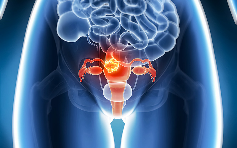 You are currently viewing Ooforectomia: protezione da tumore mammario differisce con mutazioni BRCA1/2