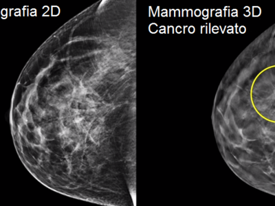 Mammografia, con lo screening 3D scoperto il 34% di tumori al seno in più