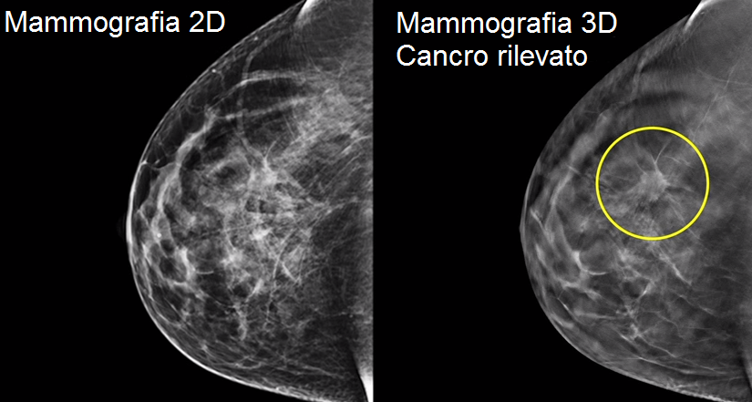 Mammografia Digitale con Tomosintesi 3D – Mammografia 3Dimensions